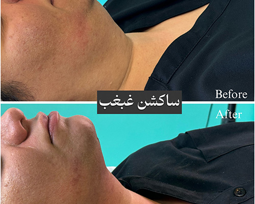 ساکشن غبغب