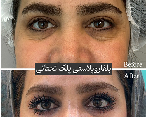 بلفاروپلاستی