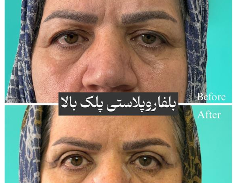 وقتی چشم‌ها خسته به نظر می‌رسند؛ روایت یک تصمیم و مسیر رسیدن به چهره‌ای شاداب‌تر