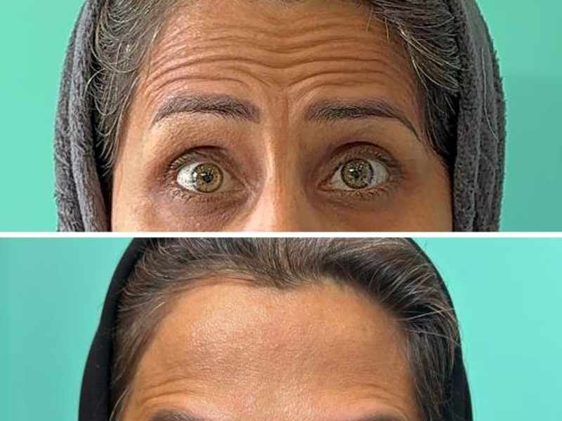 از تردید تا رضایت؛ تجربه‌هایی که قبل از جوان‌تر شدن چهره باید بدانید