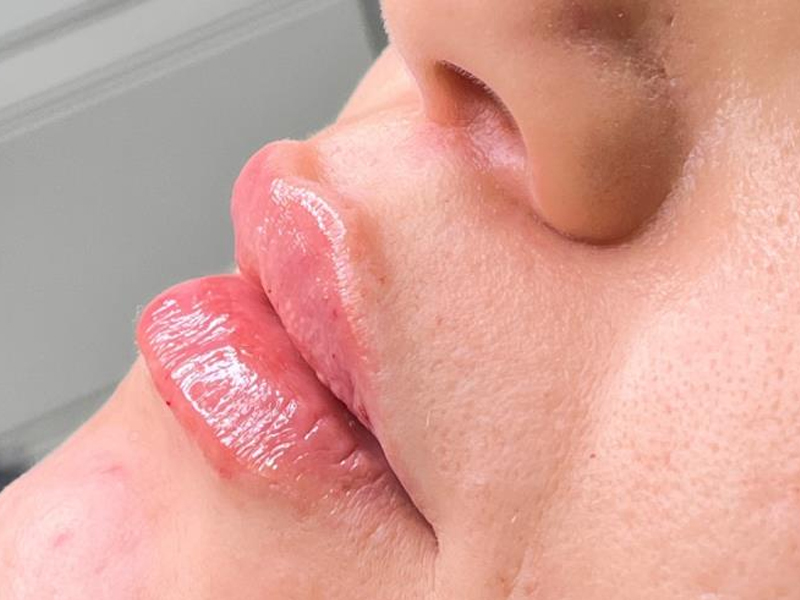 داستان یک تغییر کوچک؛ از تردید تا رسیدن به لب‌هایی متناسب‌تر